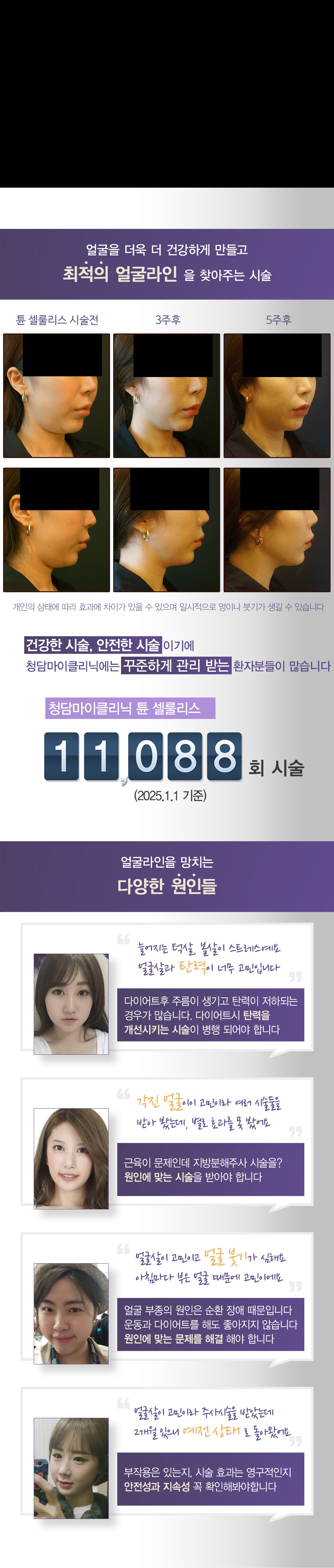 얼굴브이라인 만들기, 얼굴 셀룰리스