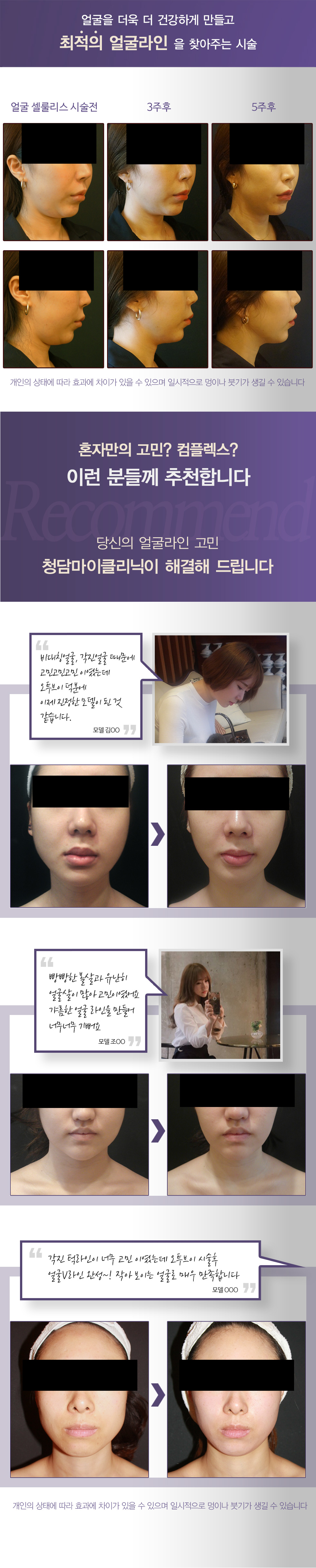 얼굴브이라인 만들기, 얼굴 셀룰리스