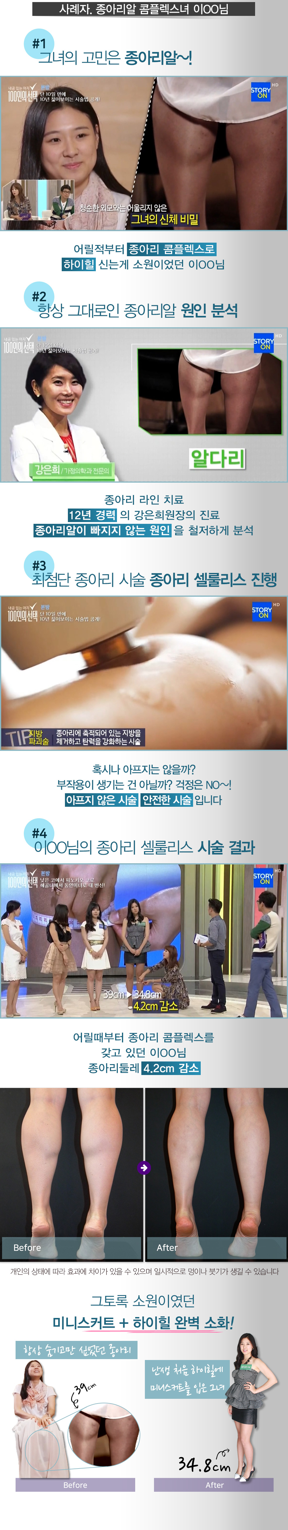 종아리 셀룰리스 04