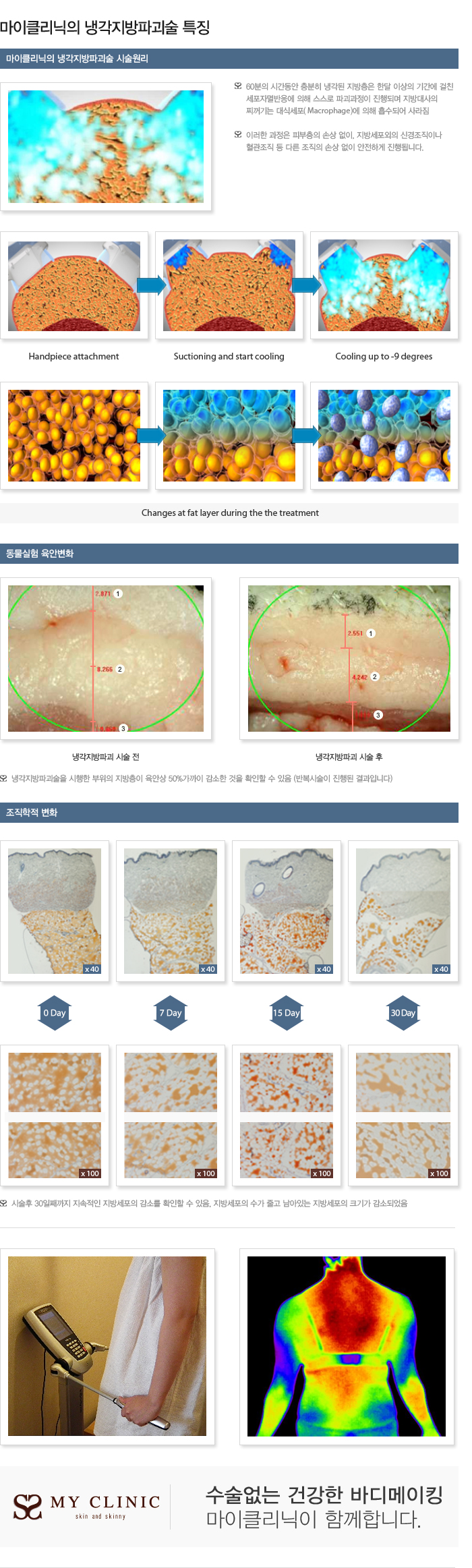 냉각지방파괴술