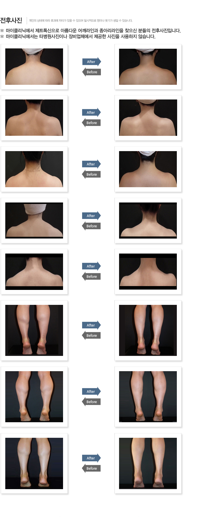 전후사진 마이클리닉에서 제트톡신으로 아름다운 어깨라인과 종아리라인을 찾으신 분들의 전후사진입니다. 마이클리닉에서는 타병원사진이나 장비업체에서 제공한 사진을 사용하지 않습니다.