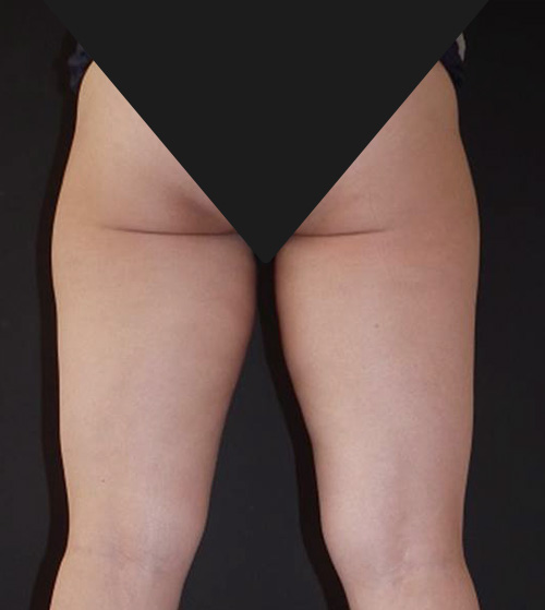 수술 후